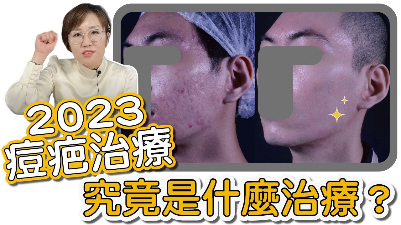 長期被痘疤困擾？2023痘疤治療的新曙光，讓你充滿自信、重拾亮眼肌膚！