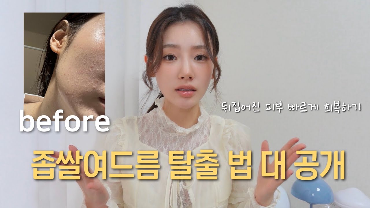 (SUB) &lsquo;피부 뒤집어진 나의 과거&hellip;좁쌀여드름 극복 법 대 공개!&rsquo; | 좁쌀 여드름 없애는 비밀 습관🤫 | 트러블 안녕 꿀템들!