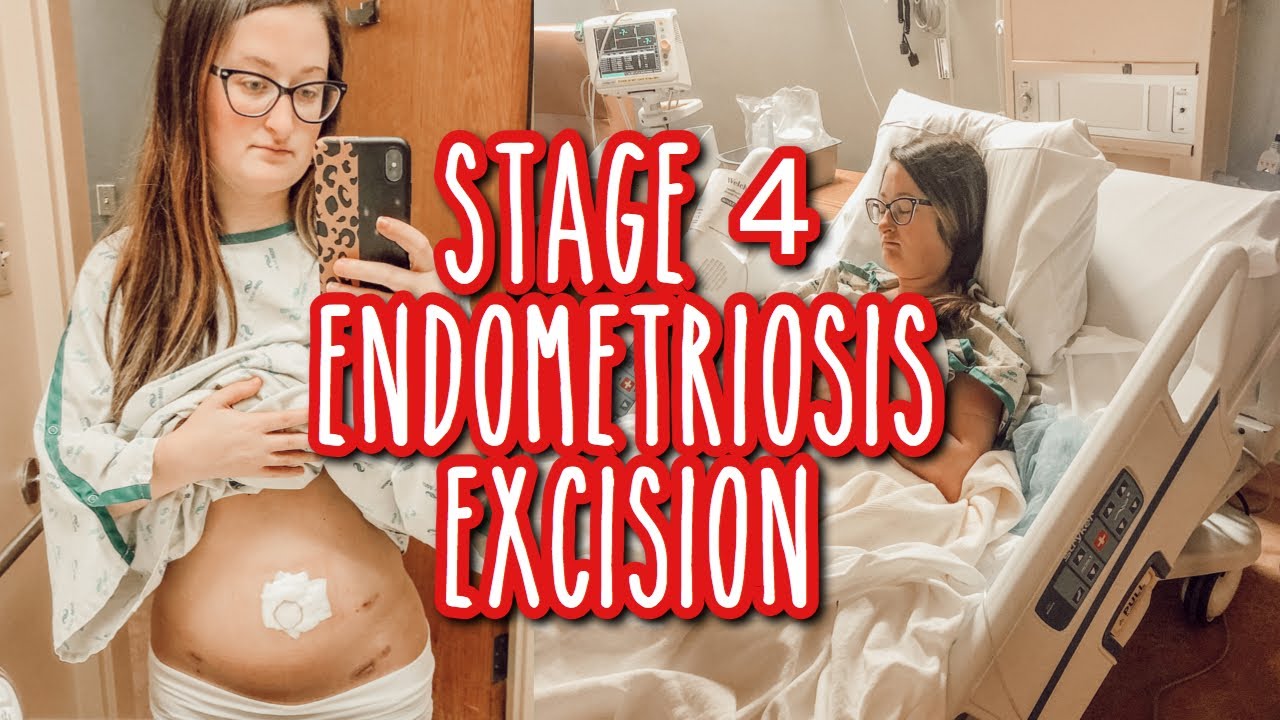 What To Expect Laparoscopy for Endometriosis
