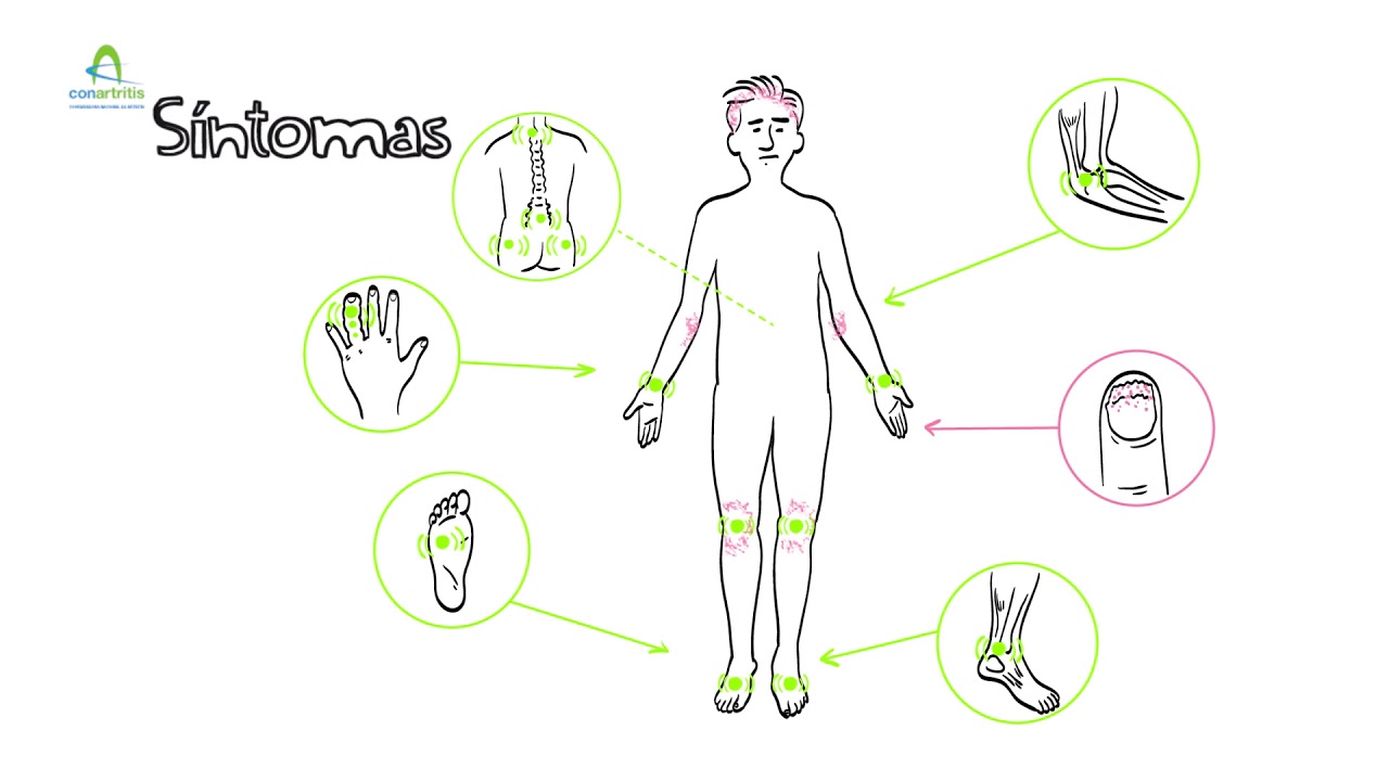 Hablemos de artritis psoriásica