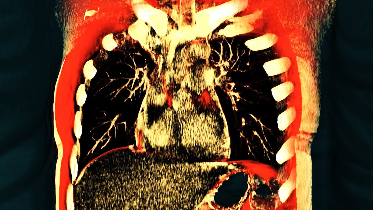 A Man Took Dinitrophenol DNP To 