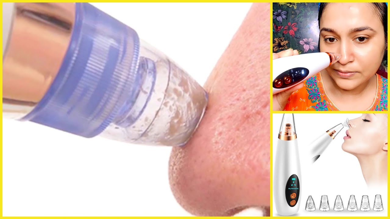 1 min blackheads & whiteheads remove method /OMG IT WORKED! /suction blackhead remover Review & Demo