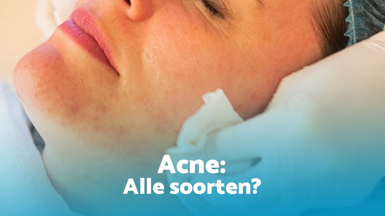 Kunnen alle soorten acne littekens behandeld worden?