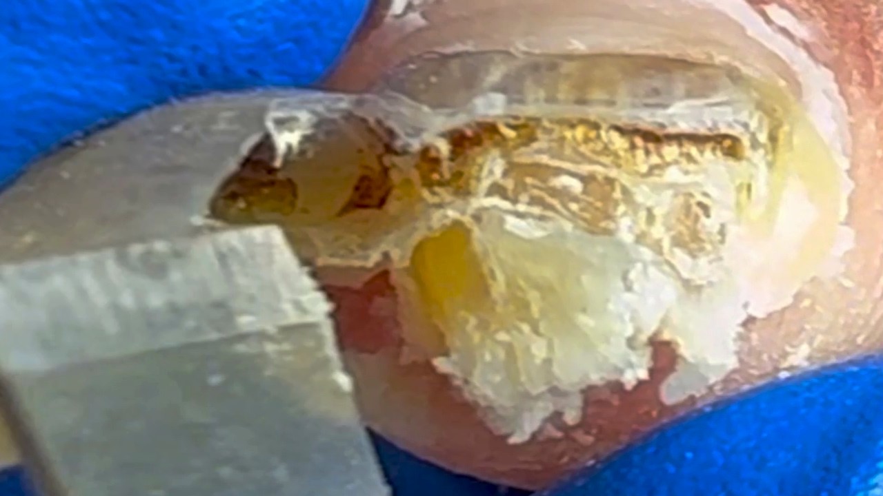 Onicomicosis de gran tamaño, completamente recortada.