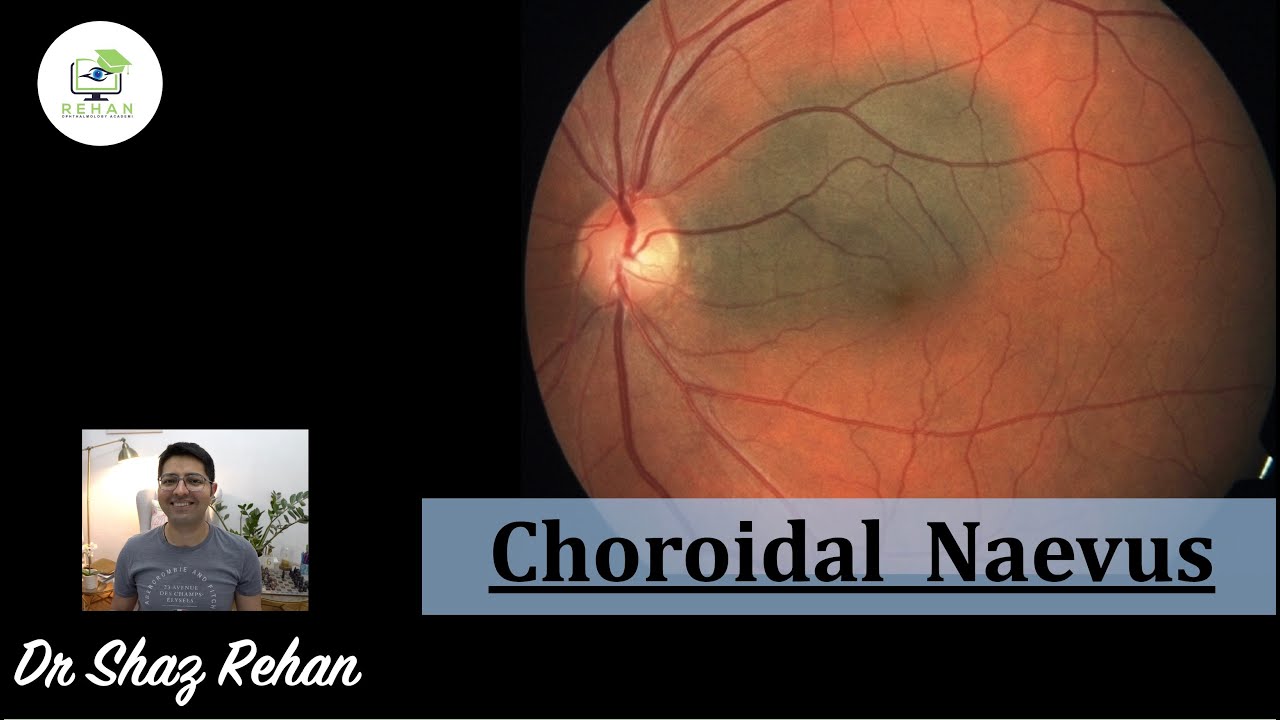 Choroidal Naevus: What is it? How is it Diagnosed? Treatment? What Else Could it be? I Rehan, 2021