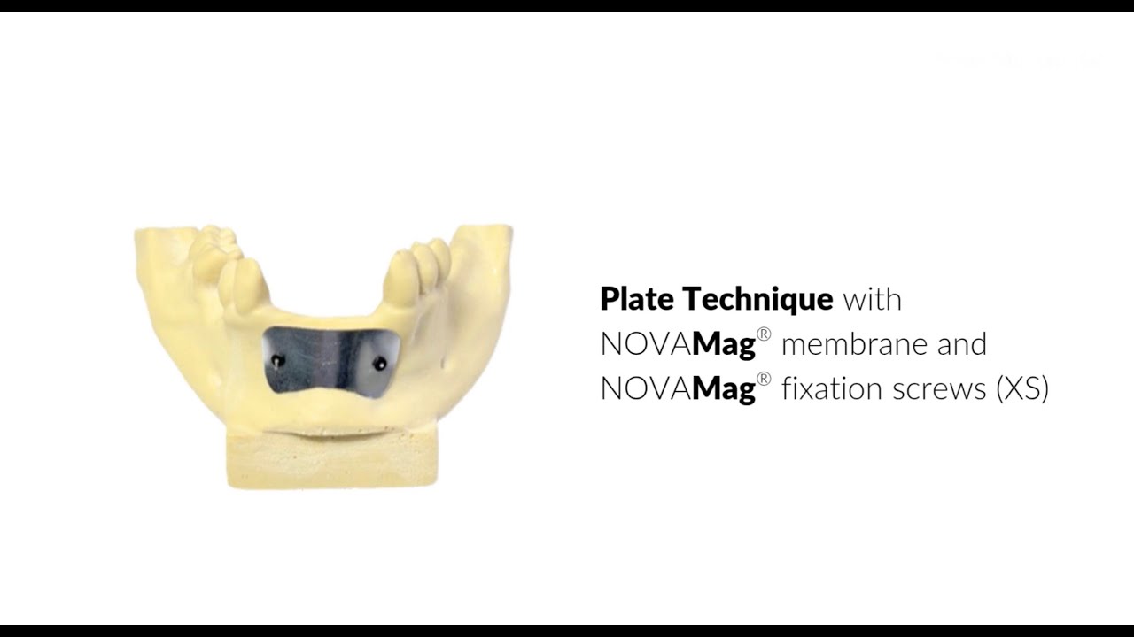 Plate Technique with NOVAMag® membrane and NOVAMag® fixation screws (XS)