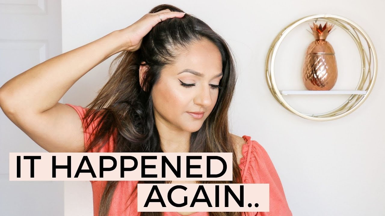 5 Year Alopecia Update