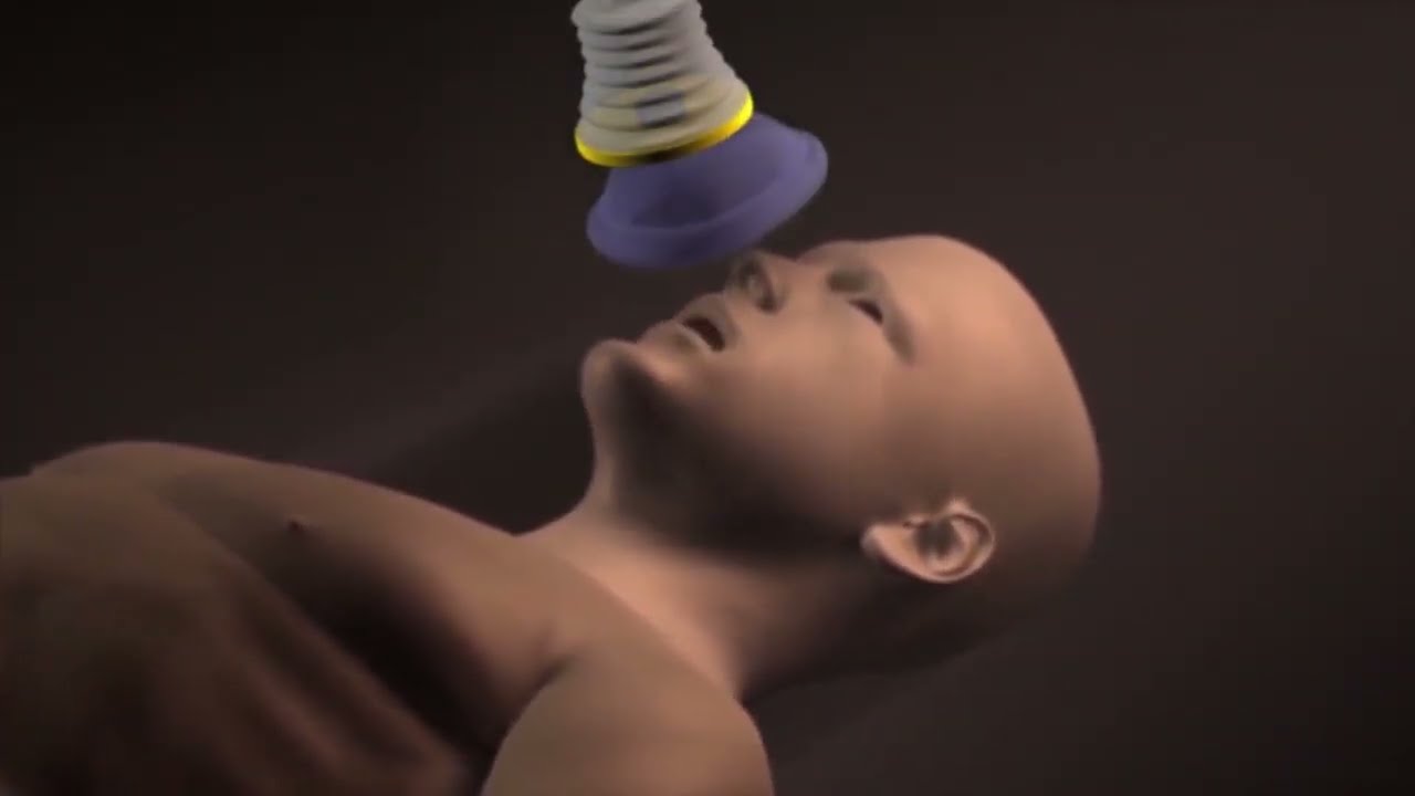 LifeVac &ndash; Urządzenie do udrażniania dr&oacute;g oddechowych (zasada działania).