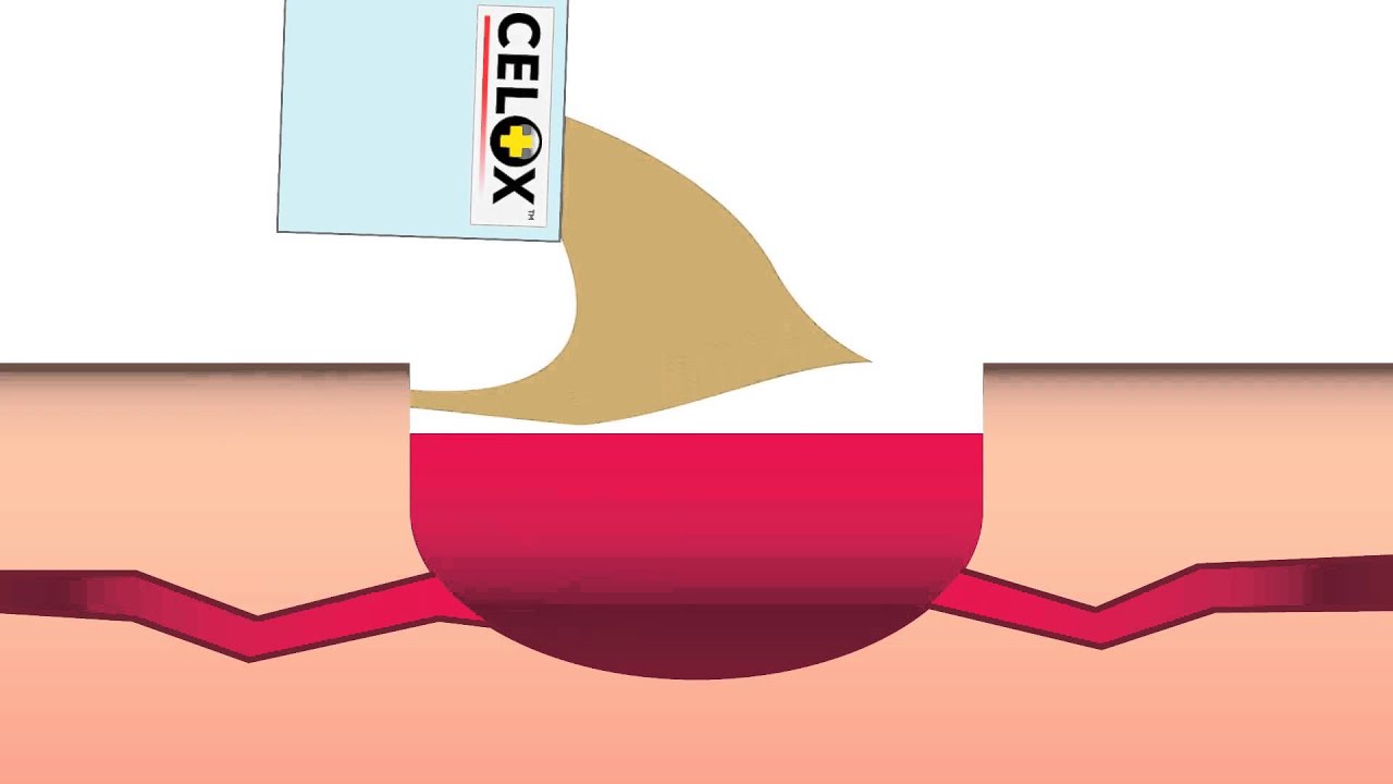 Celox Granules -- Training animation