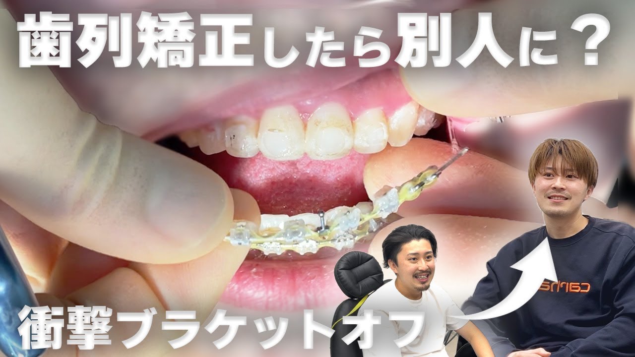【お顔激変】ついに矯正終了！器具を外します【男性の矯正】