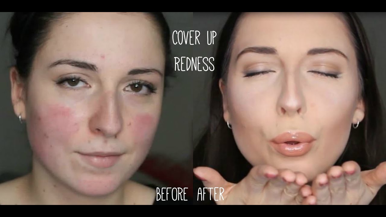 Make-Up Tutorial for Rosacea || Party Camouflage + Contouring Make-up