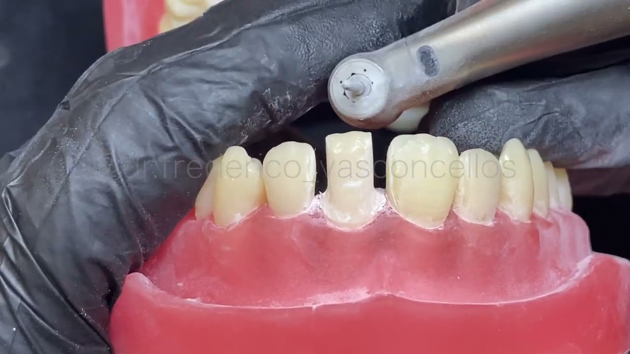 Preparo de coroa total dente 11