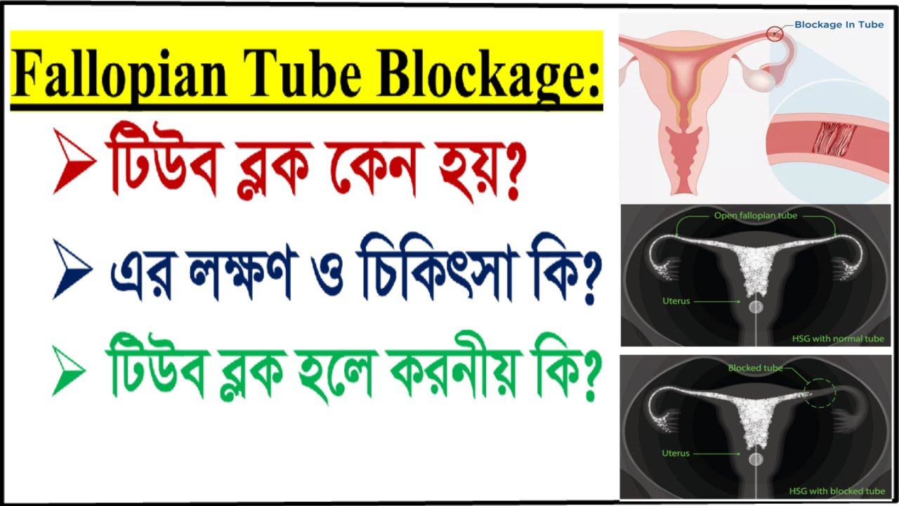 ফ্যালোপিয়ান টিউব ব্লক হওয়ার কারন ও লক্ষণ গুলো কি কি? গর্ভধারণের উপায় কি? Fallopian tube blockage