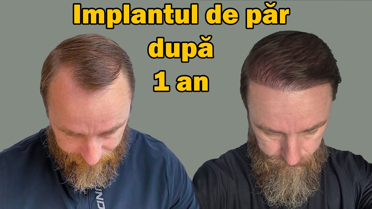 Implantul de păr - rezultate reale după 1 an