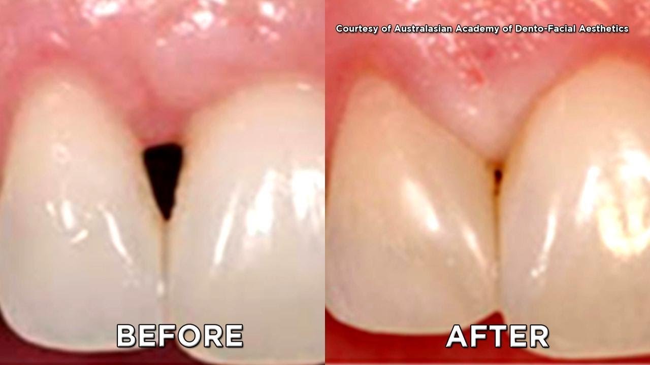 Would You Try Filler for Your Receding Gums?