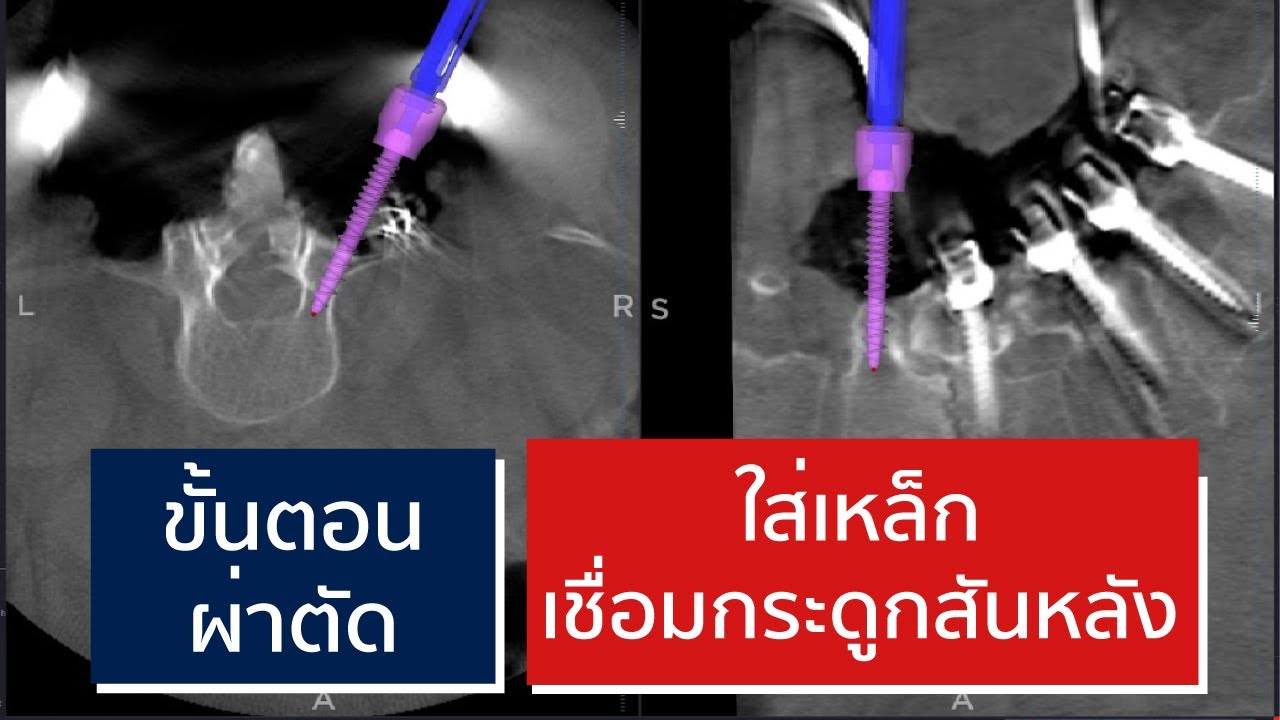 ผ่าตัดเชื่อมข้อกระดูกสันหลัง ทำอย่างไร | EasyDoc  EP.27