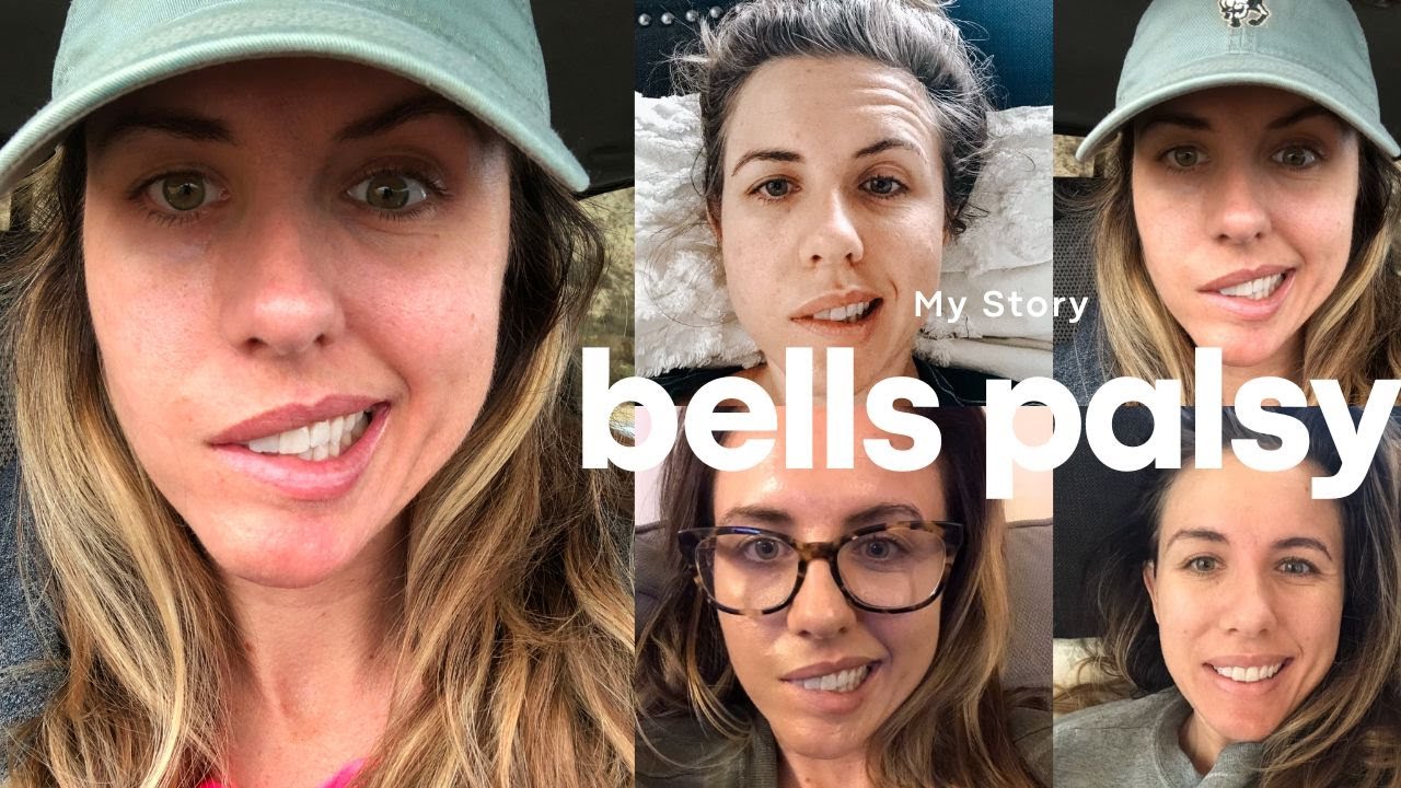 My Bells Palsy Sotry- Recovery Story & My Signs and Symptoms!!!
