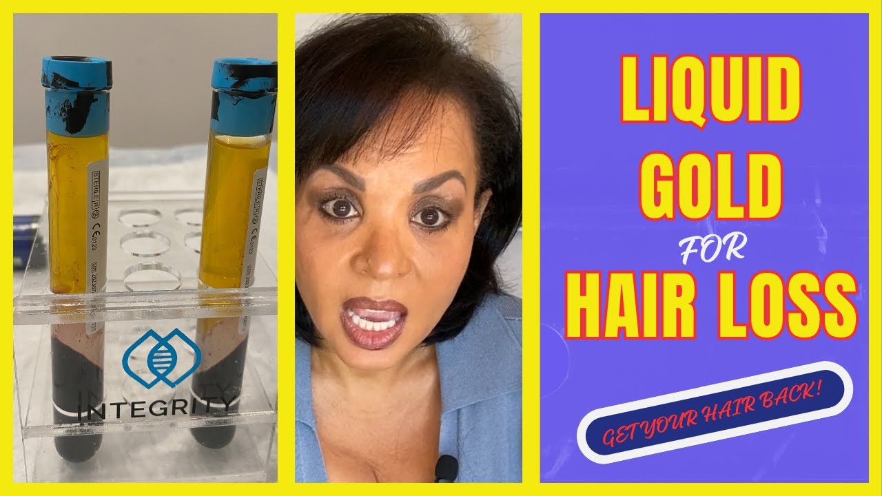 #1 Thing that Reversed My Hair Loss…PRP, Worth It?
