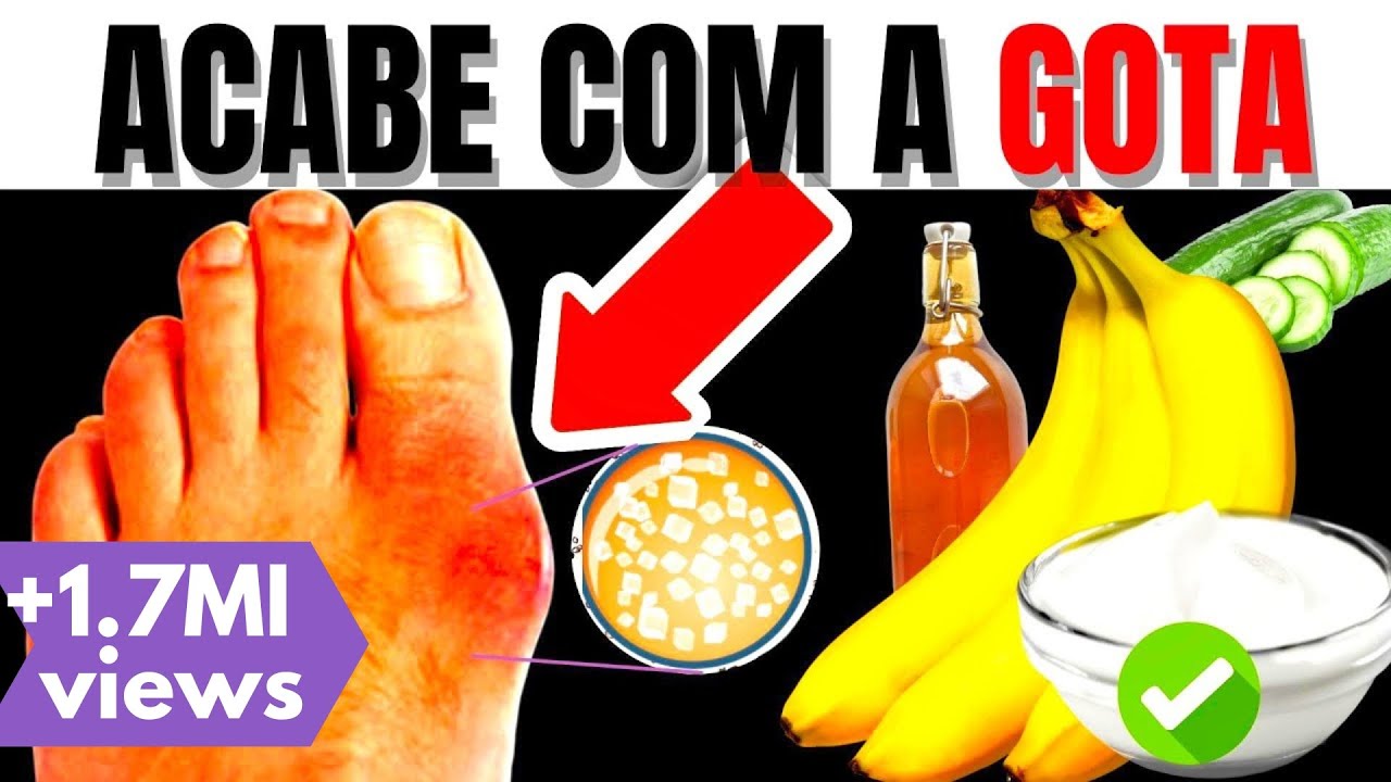 10 ALIMENTOS PARA ACABAR com a GOTA e para BAIXAR o ÁCIDO ÚRICO ALTO DO SANGUE