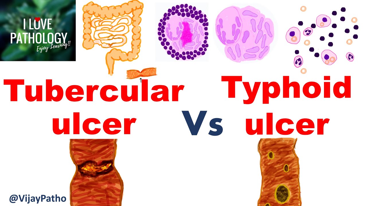 Intestinal ulcers: TUBERCULAR VS TYPHOID ULCER