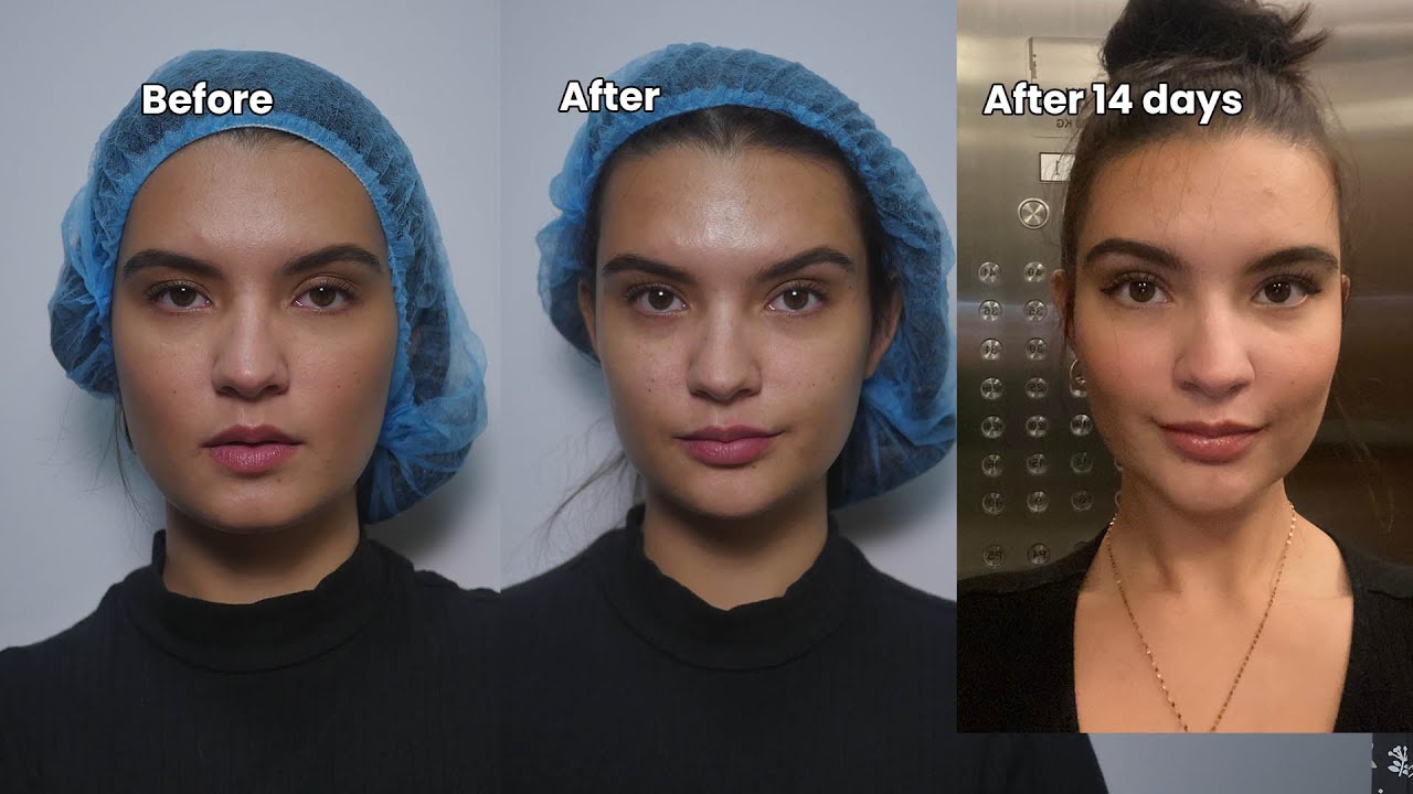 Enhancing key attraction points of the face  fox eye thread lift , lip and chin enhancements