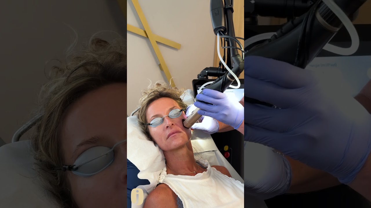 Soft-Lift mit dem ALMA Hybrid Laser