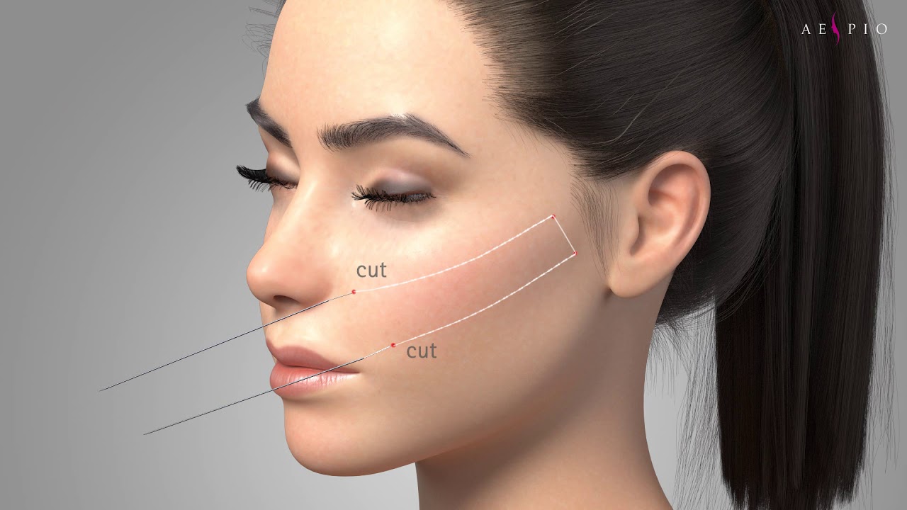 LFL ANCHOR DX (Double Needle)