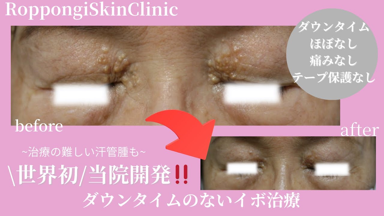 【世界初‼️当院開発】ダウンタイムのないイボ治療~汗管腫・皮脂腺増殖症にも効果あり