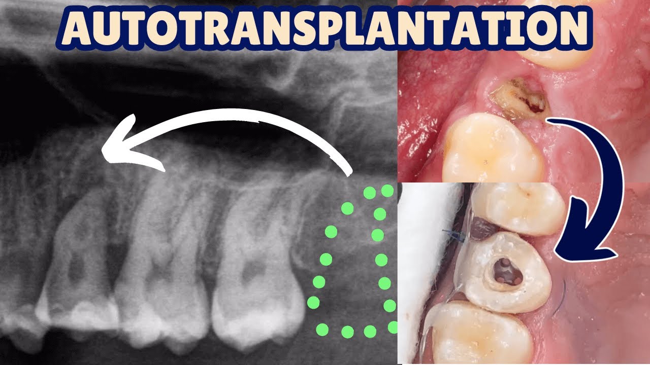 Replacing Premolars with Wisdom Teeth - Auto Transplantation by a GDP! - PDP193