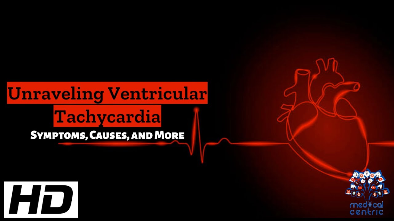 Ventricular Tachycardia Exposed: Symptoms, Causes, and Your Treatment Options
