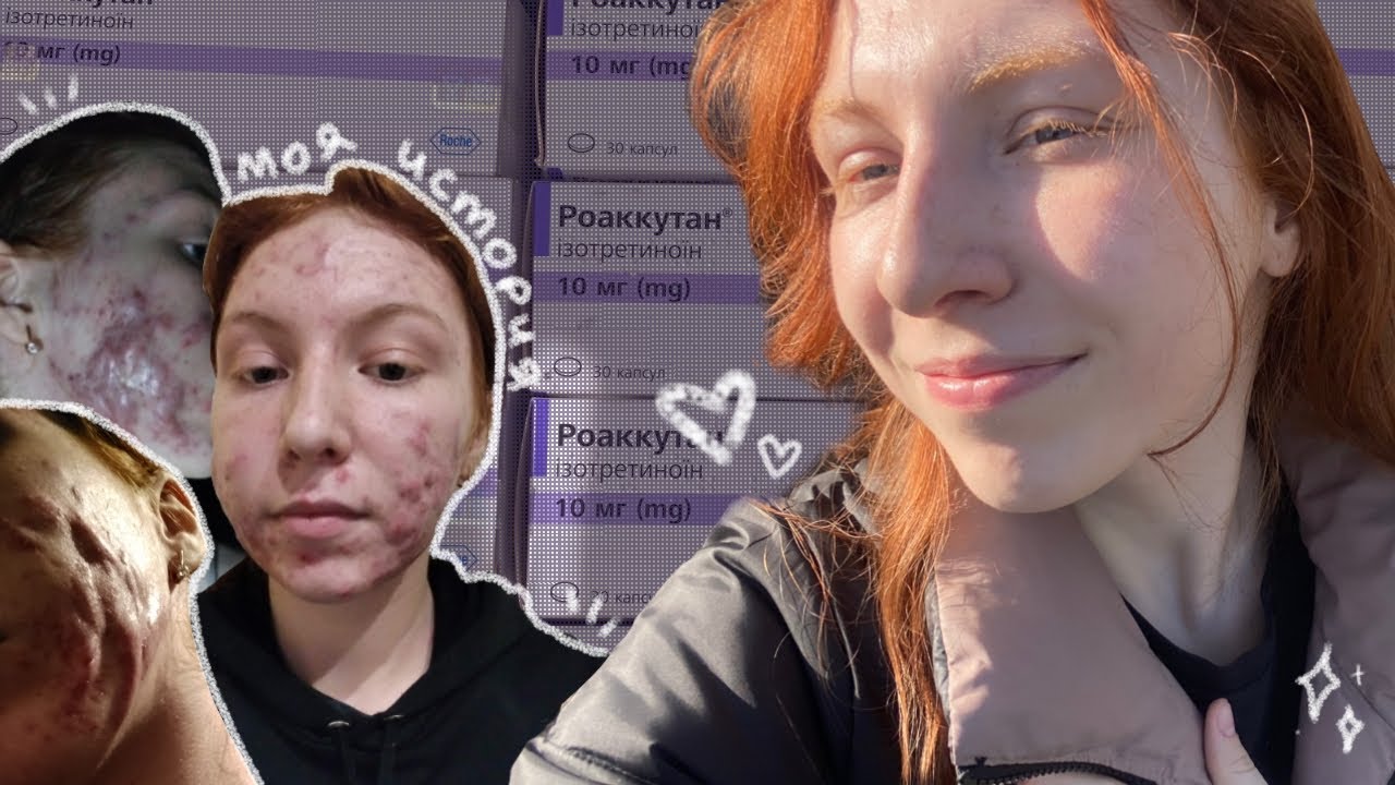 Моя история лечения акне: тяжёлая степень и ретиноиды ❀