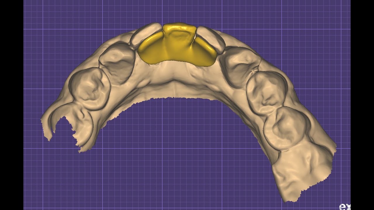 How to design for maryland bridge for lower anterior in Exocad?