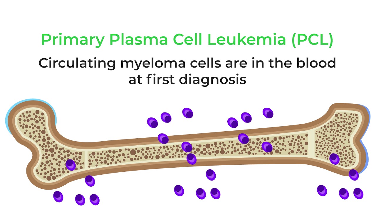 Primary vs. Secondary Plasma Cell Leukemia: What&rsquo;s the Difference? #myeloma
