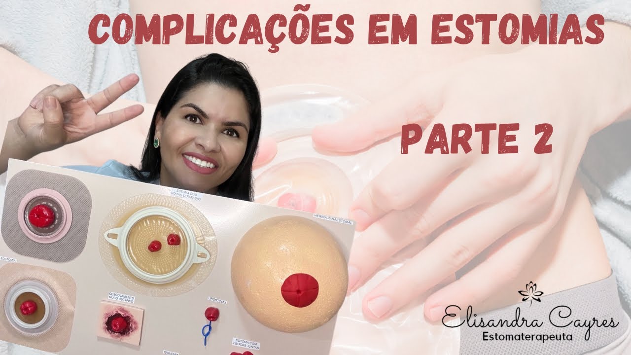 COMPLICAÇÕES DE ESTOMIAS - PARTE 2