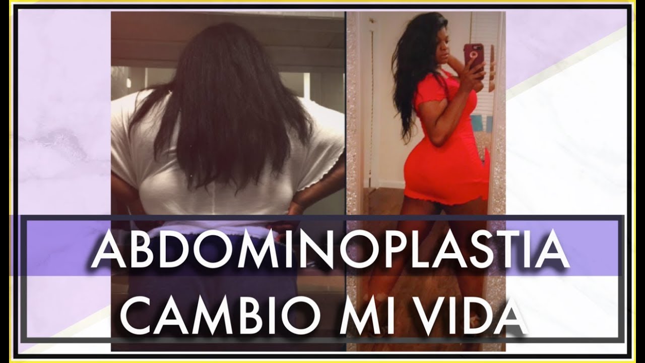 Resultados de abdominoplastia luego de su p&eacute;rdida de peso | Dr.Cortes Cirujano Plastico | Houston TX