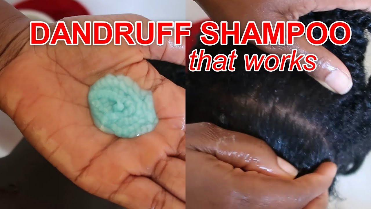 Best SHAMPOO for Dandruff | How to use Nizoral Anti-Dandruff Shampoo | Discoveringnatural