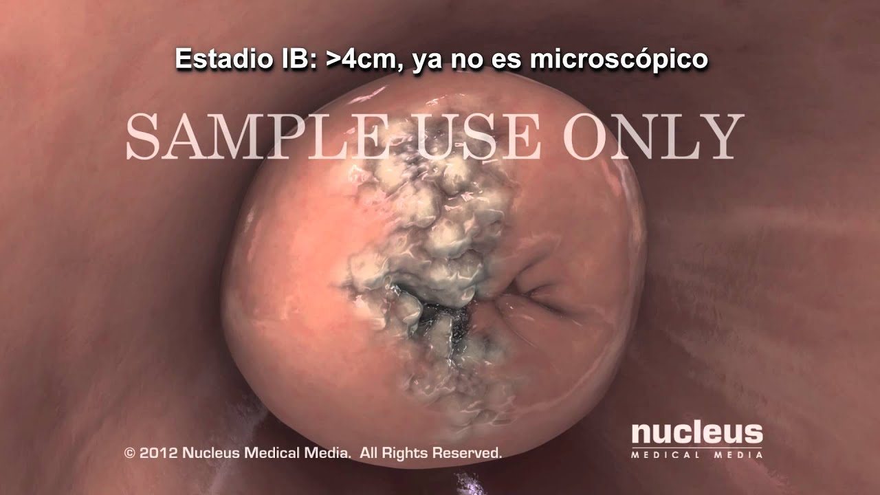 Progreso y estadificación del cáncer de cuello uterino