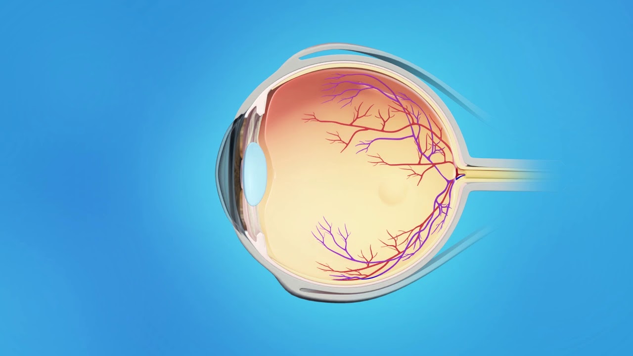 Detached Retina: Vitrectomy