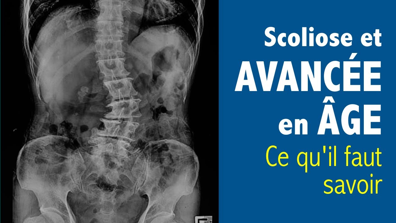 👉 Scoliose et avancée en âge : ce qu’il faut savoir !