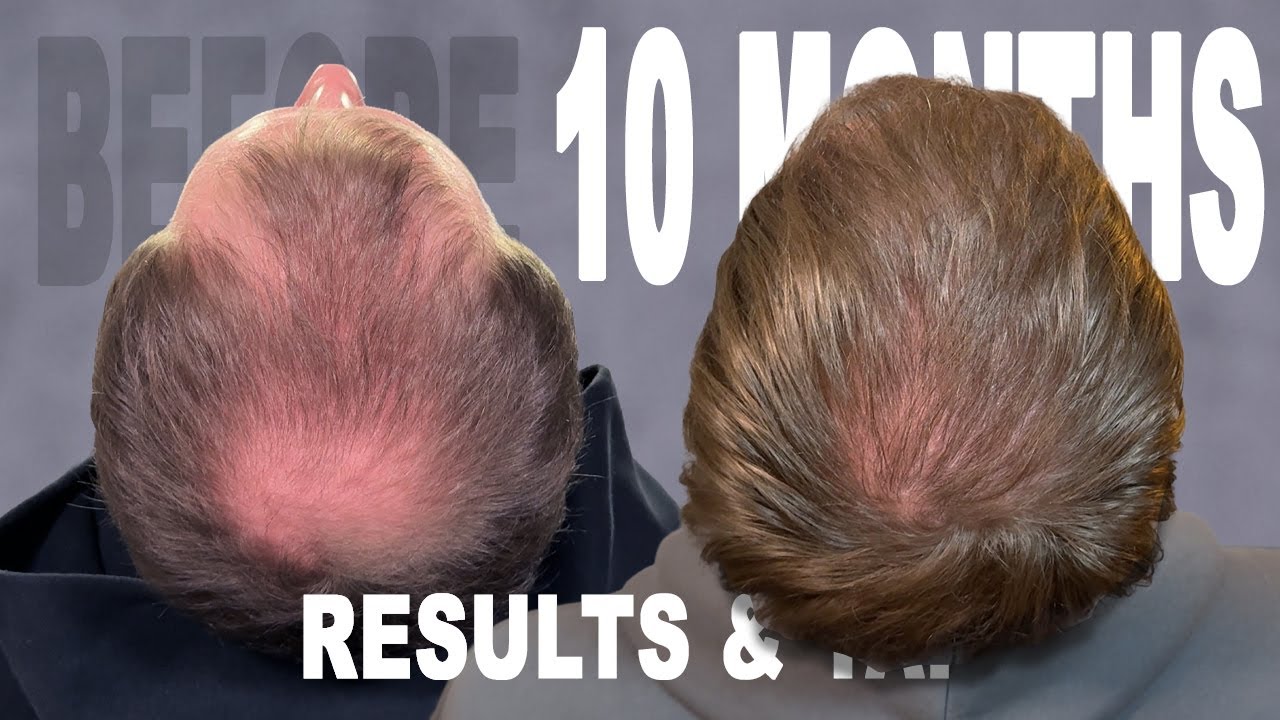 10 МЕСЯЦЕВ | ПЕРЕСАДКА ВОЛОС | КЛИНИКА COSMEDICA