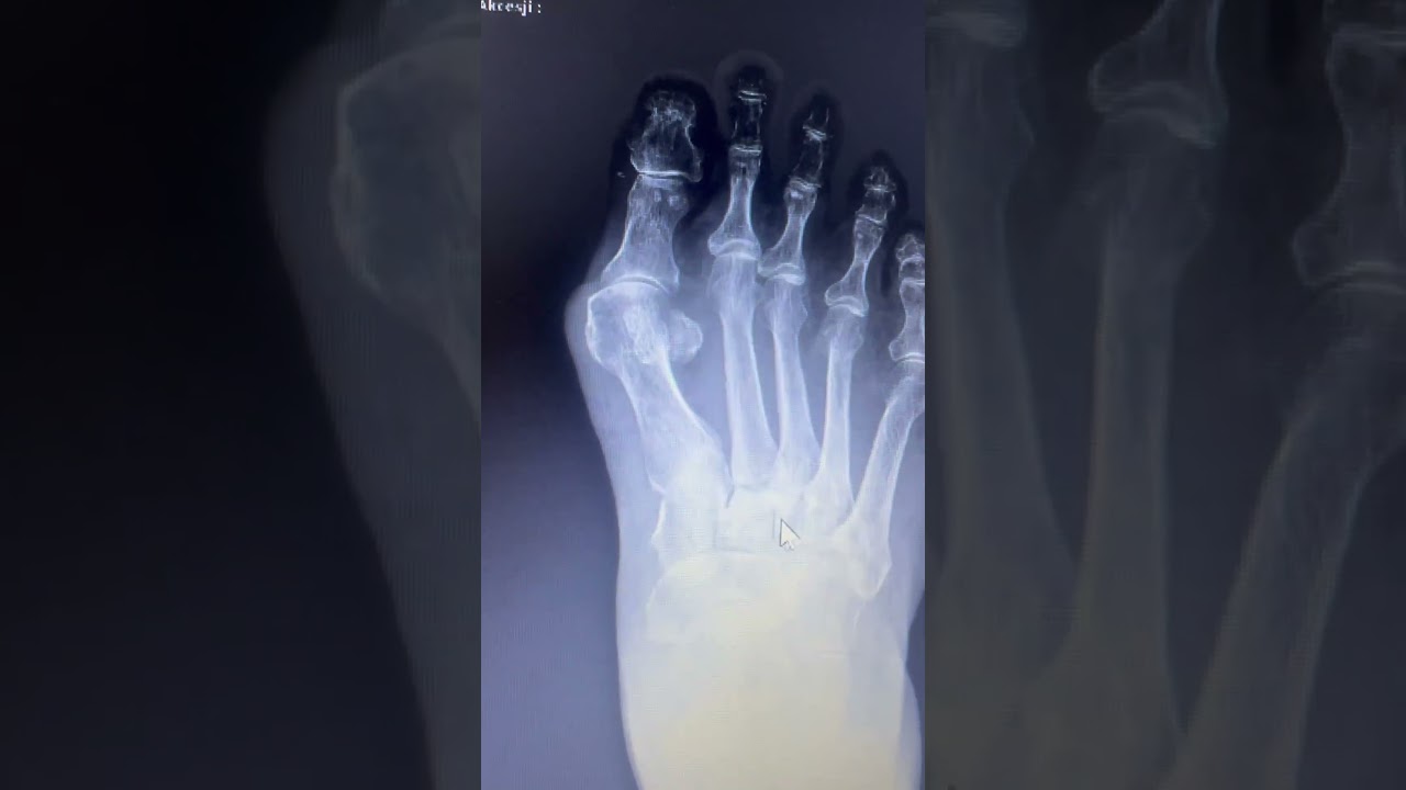 Haluks do operacji❗️#fizjoidea #hallux #haluks #haluksy #stopa #operacja