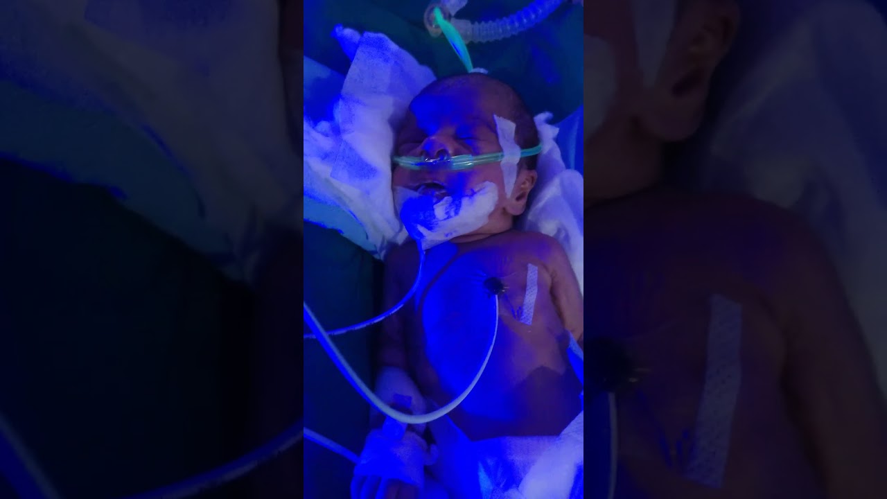Nasal HFO | Non Invasive HFO | Ventilator | NICU