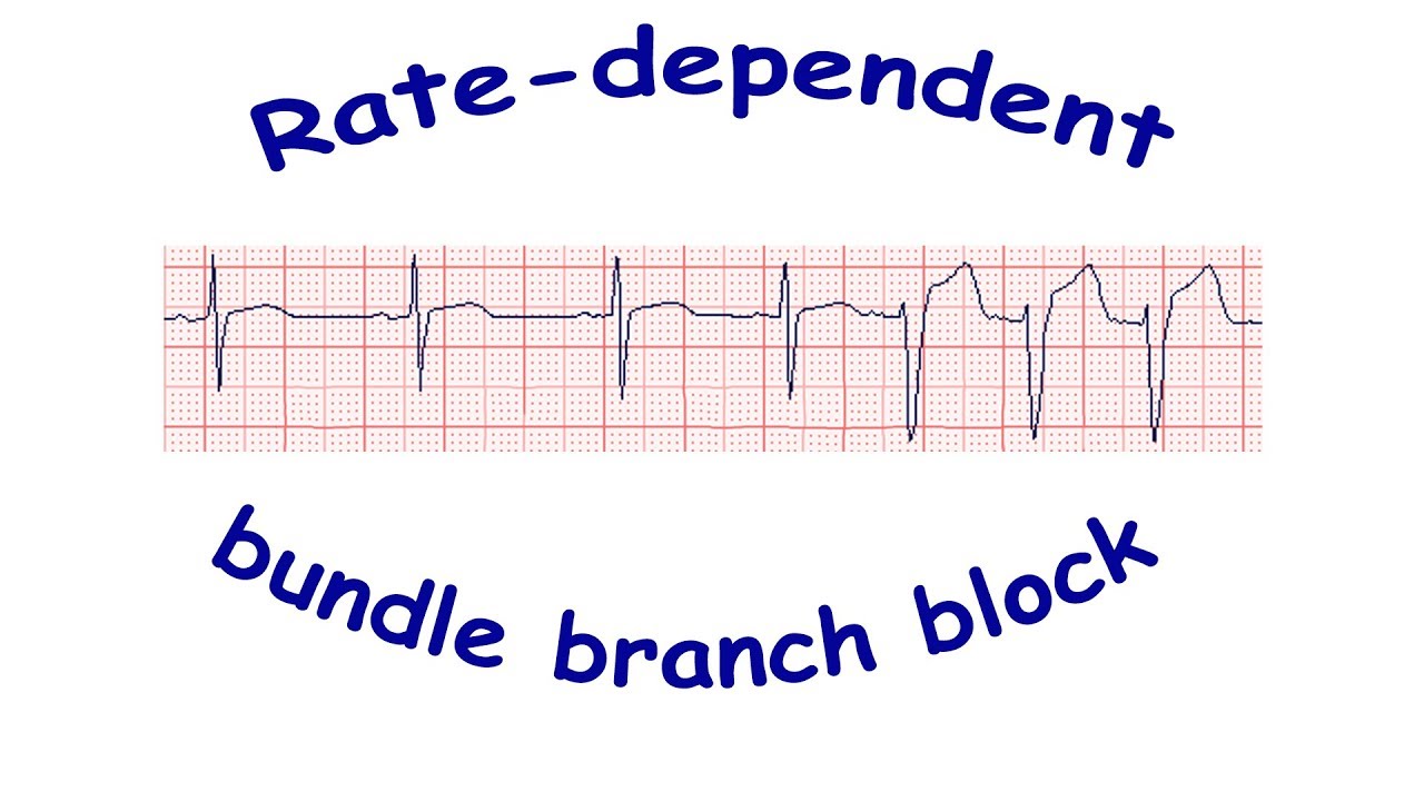 Rate-dependent bundle branch block