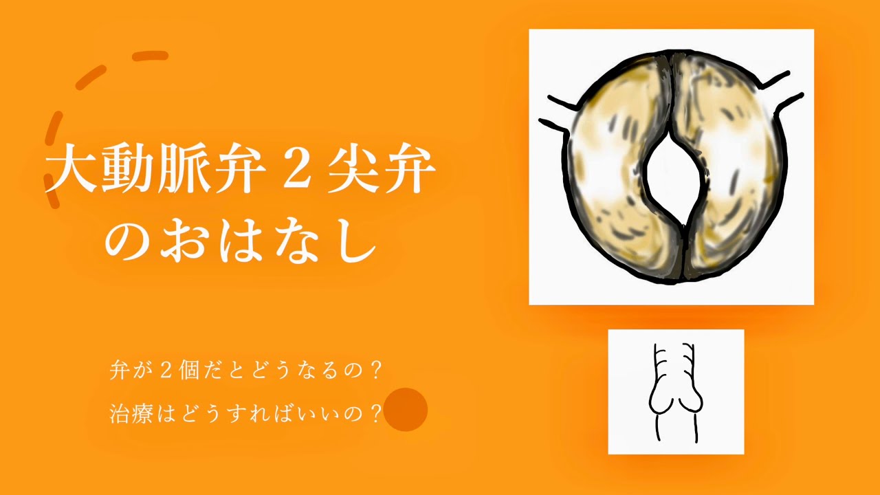大動脈弁二尖弁のおはなし