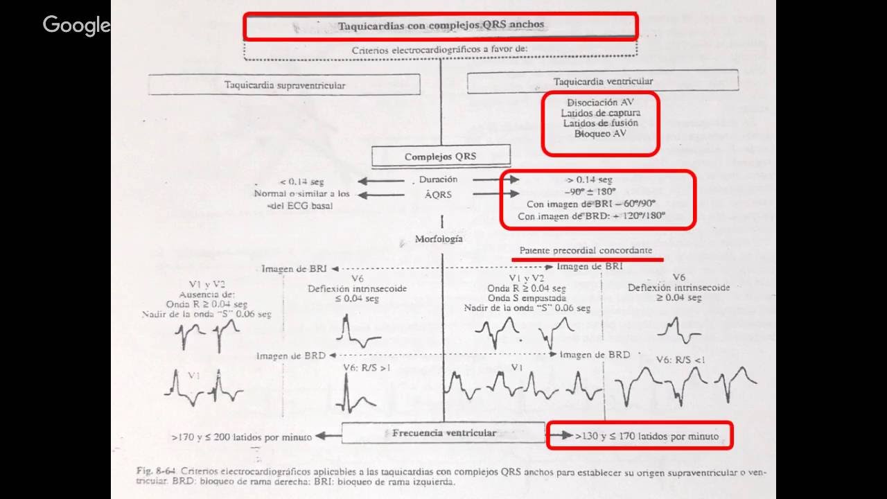 TAQUICARDIA VENTRICULAR