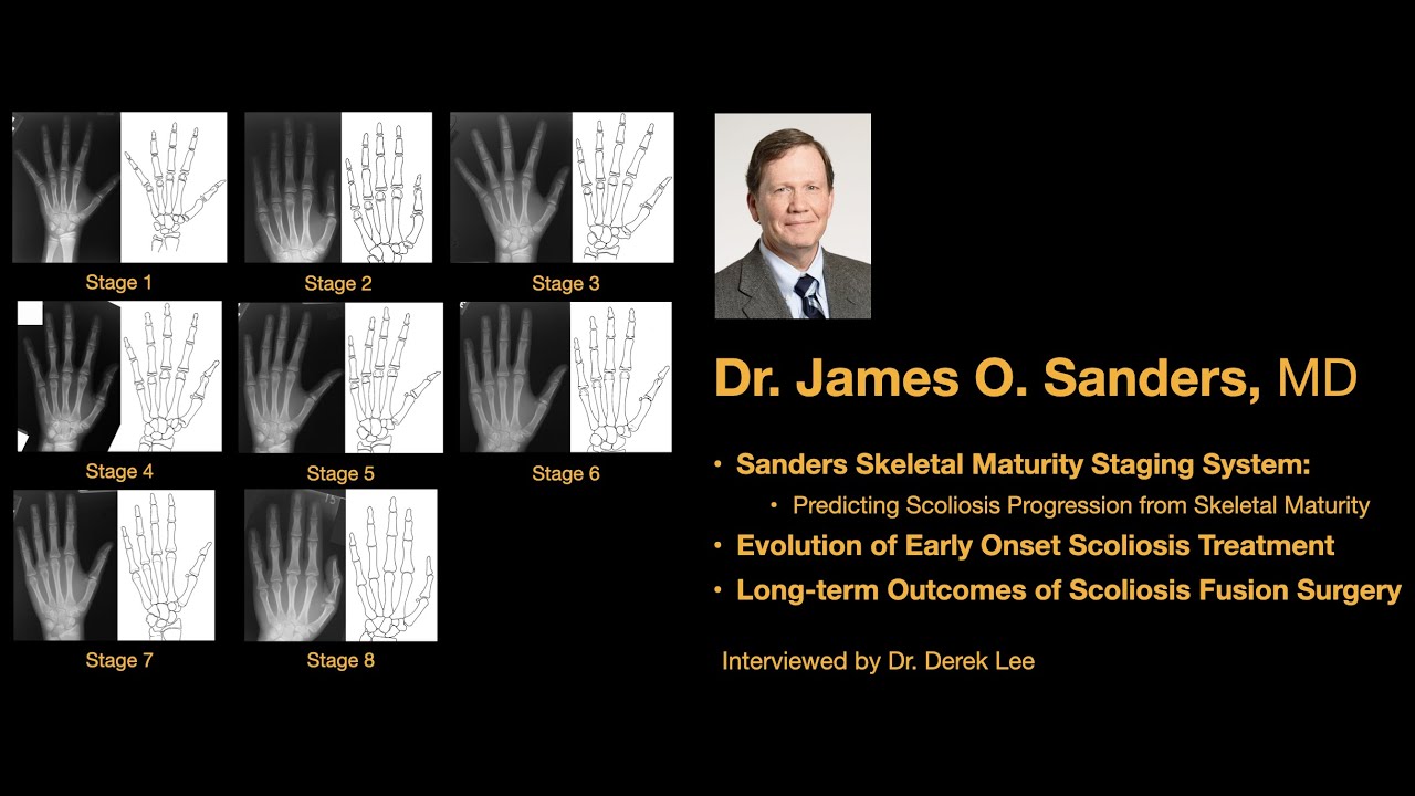 Dr. James O. Sanders, MD, Sanders Skeletal Maturity Staging, Evolution of EOS, Outcome of AIS Fusion