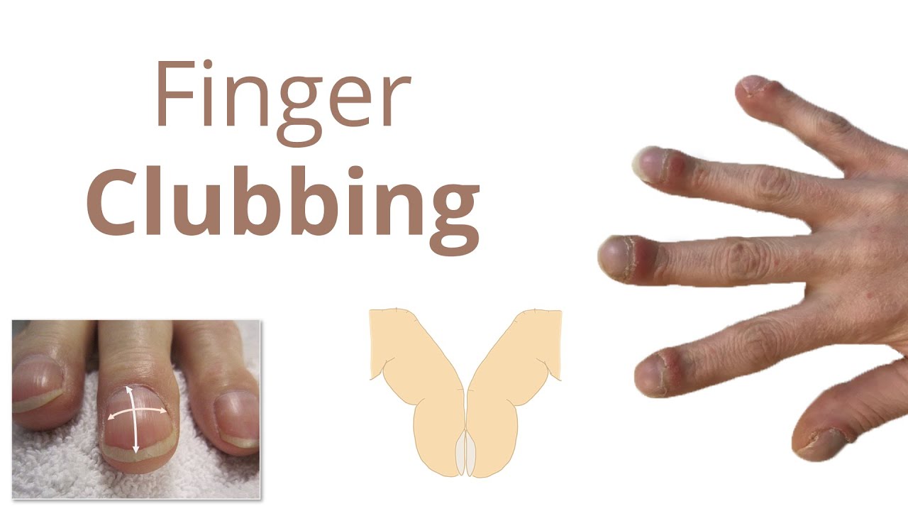 Finger Clubbing - Introduction, Pathophysiology & Causes - Mnemonic to remember causes of CLUBBING❤️