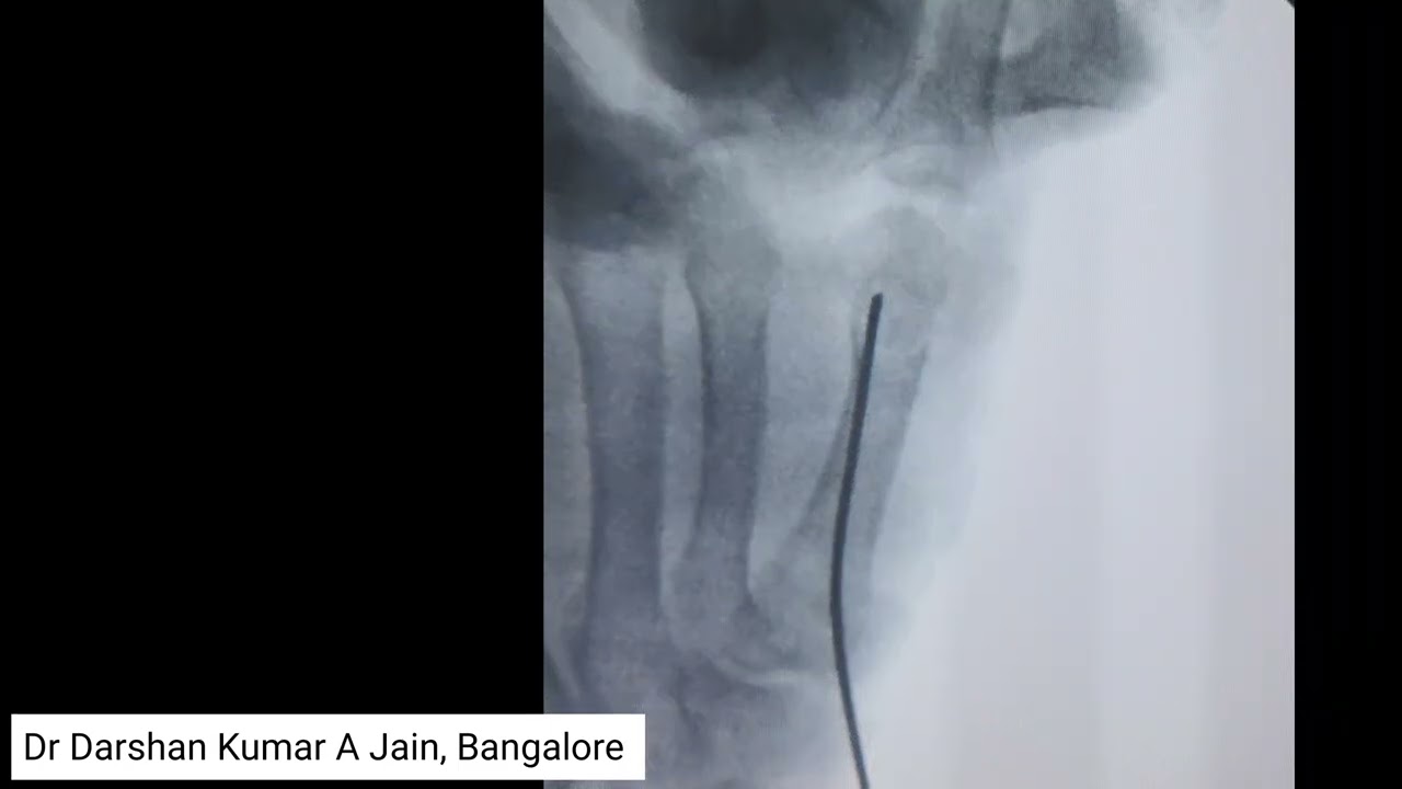 'K' wire fixation - Bouquet technique #handinjury