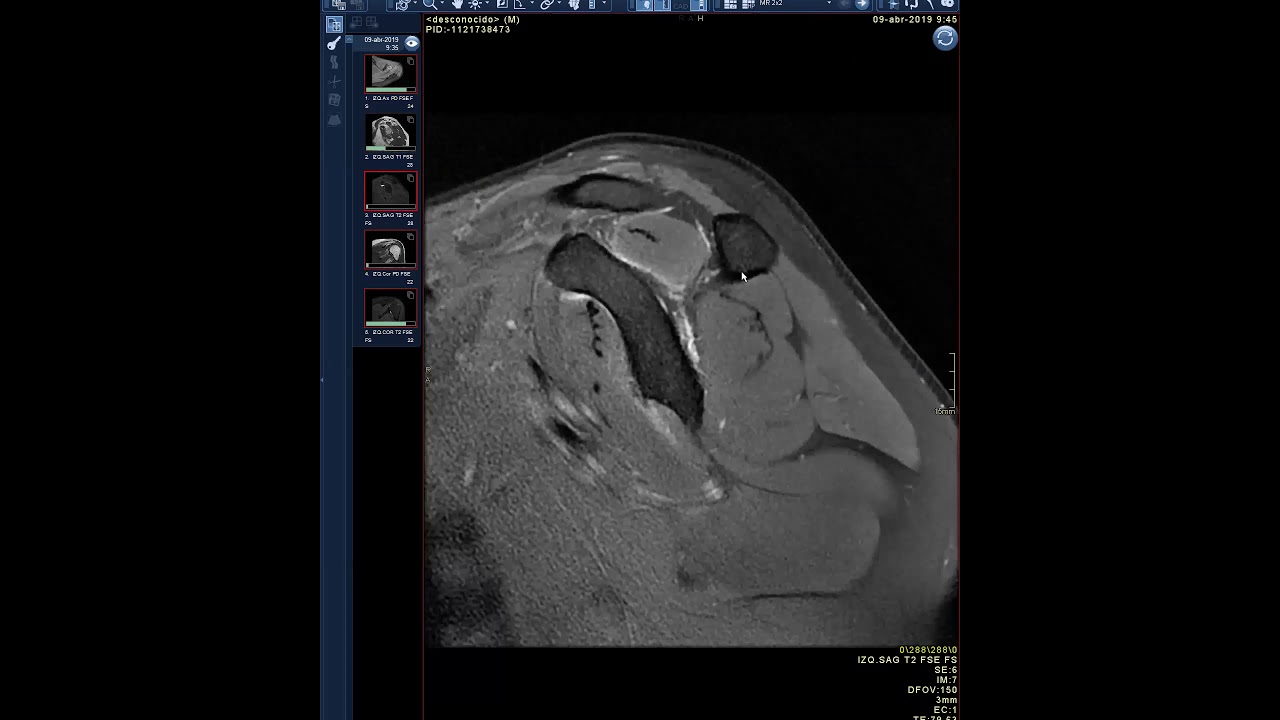 Imagenología en lesiones de labrum