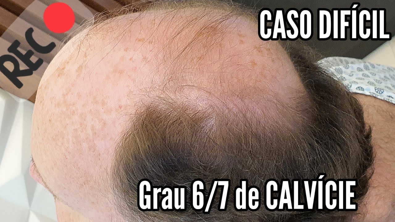 Grau 6 para 7 de CALVÍCIETransplante Capilar FUE